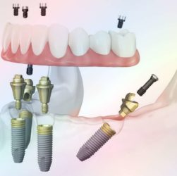 Доступные типы зубных имплантатов