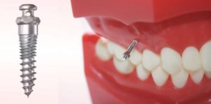 доступные типы зубных имплантатов в стоматологии